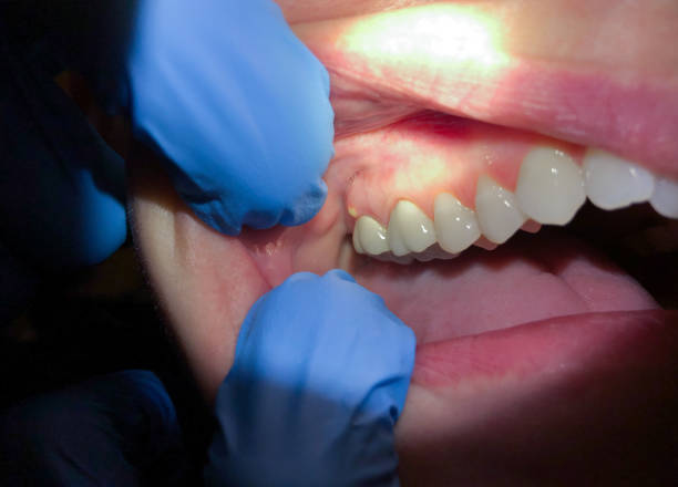 Best Broken or Chipped Tooth Repair in Calverton, NY